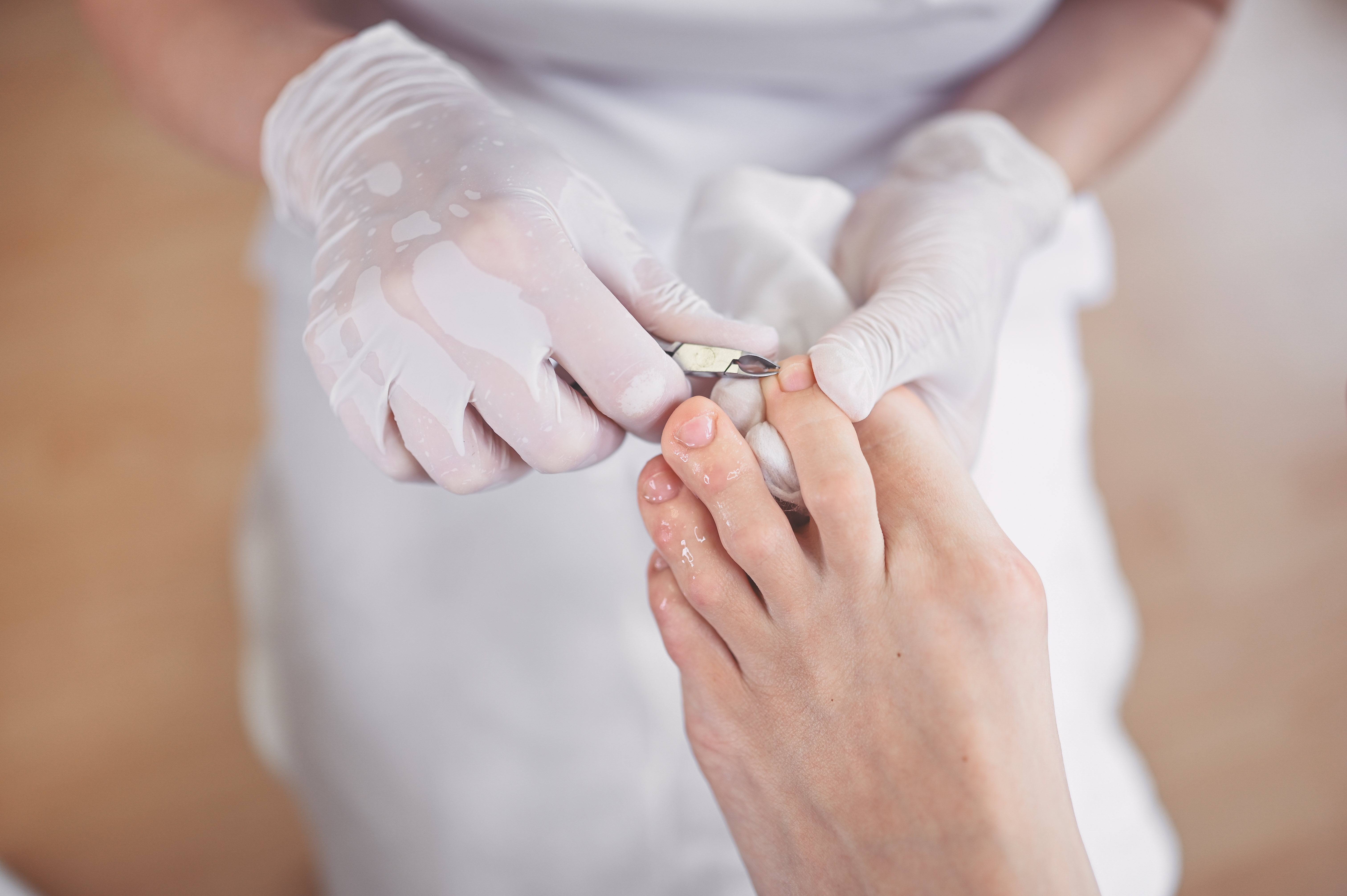 orthesiologie nagelregulatie nagelreparatie & anti-druk technieken door Medisch Pedicure Sandra Middeldorp